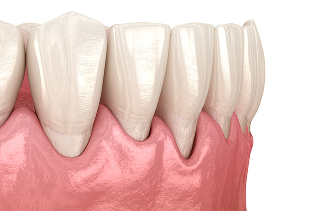 歯周組織再生療法（保険適用